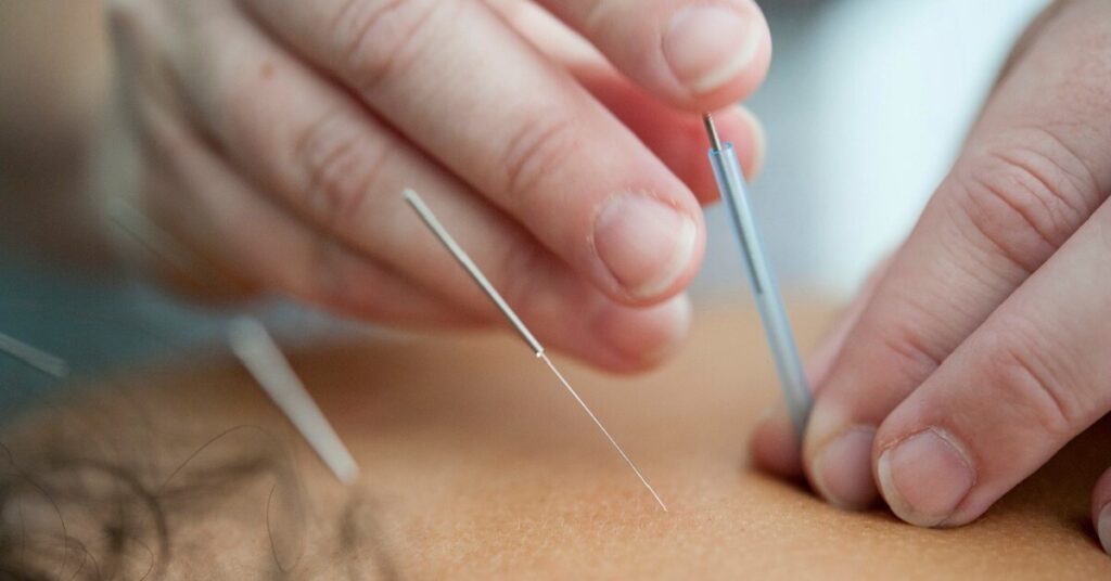 is Medicare cover under acupuncture? How to get acupuncture covered by insurance