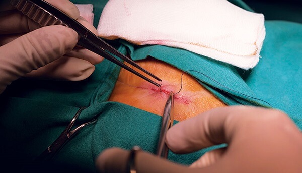 Identifying the subcategory for the location of the wound