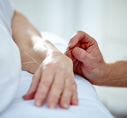 What is acupuncture
